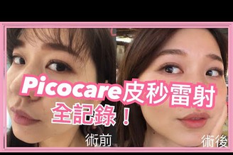 【保養】Picocare皮秒雷射全記錄！這麼神奇？真能改善斑點毛孔？