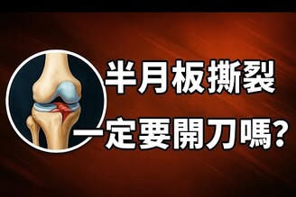 半月板 = 膝蓋避震器！受傷後要復健還是開刀