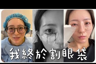 我去做眼袋內開手術我在韓國還是台灣做手術中途大量出血費用/恢復期/術後保養     中/  MENG  孟潔